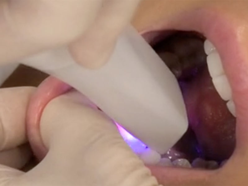 Tooth Scanner